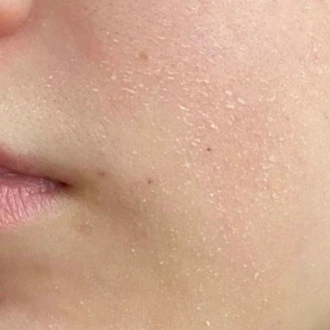 Dry Skin