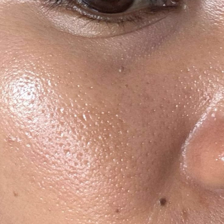 Oily Skin