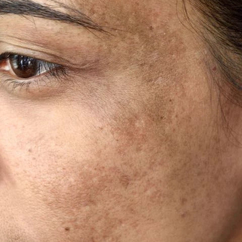 Pigmentation